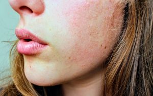 Piel Rosacea